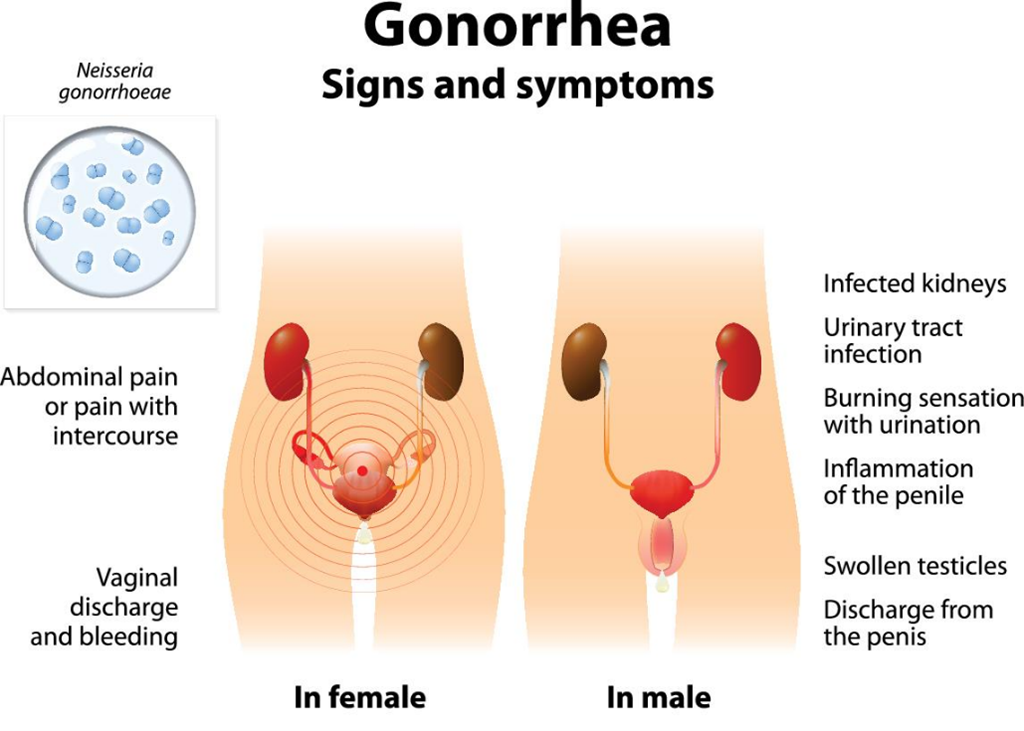Gonorrhea Gonorrhea