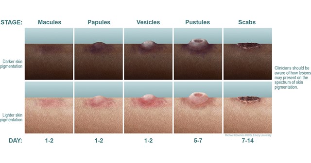 Mpox Info Graphic Mpox Progression